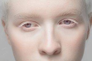 El albinismo ocular afecta solo los ojos y los vuelve más susceptibles
